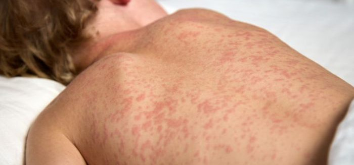 Alerta de sarampo nas Américas mobiliza vigilância sanitária no Brasil