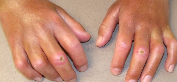 Esclerose sistêmica: a doença rara que exige atenção