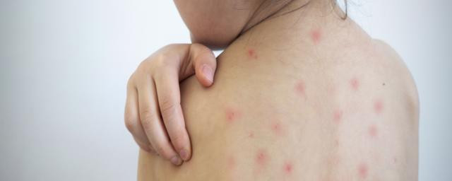 Blumenau registra primeiro caso de sarampo dos últimos 16 anos