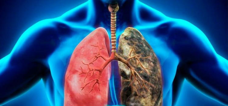Sul apresenta a maior incidência de câncer de pulmão